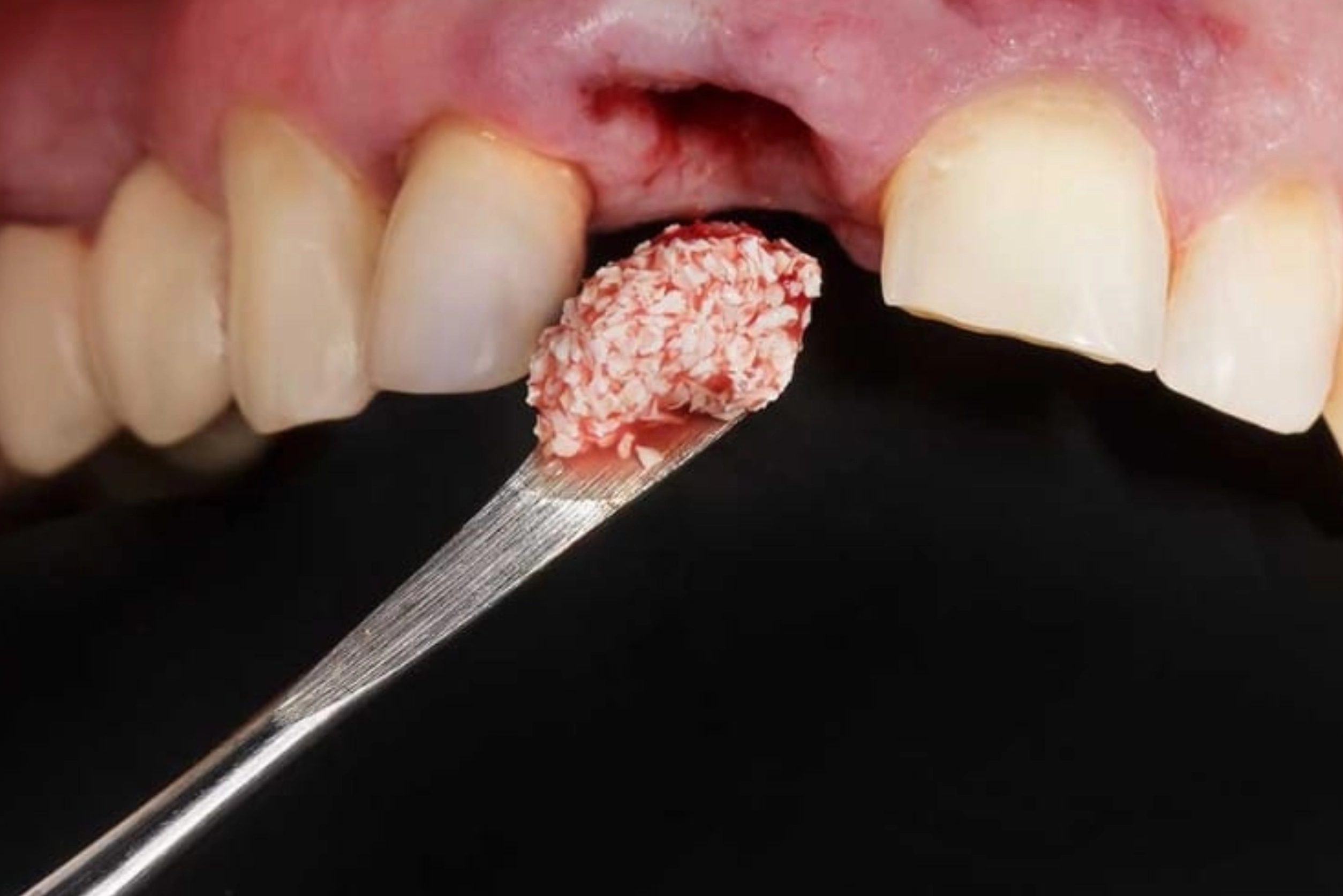 Bone Grafting