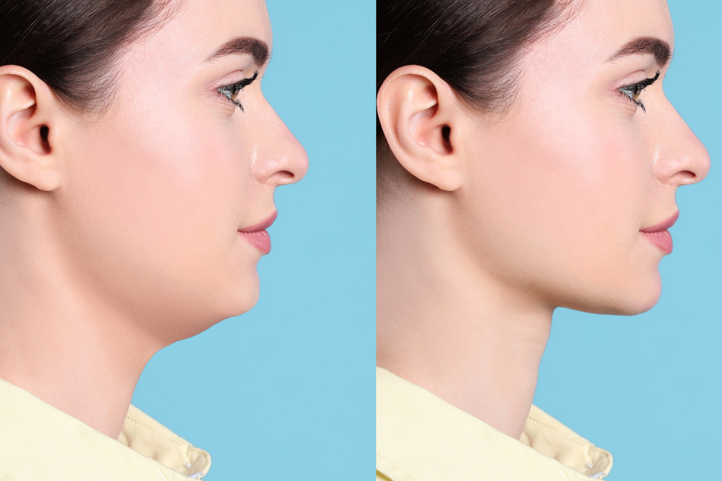 Face correction and lifting to reshape chin