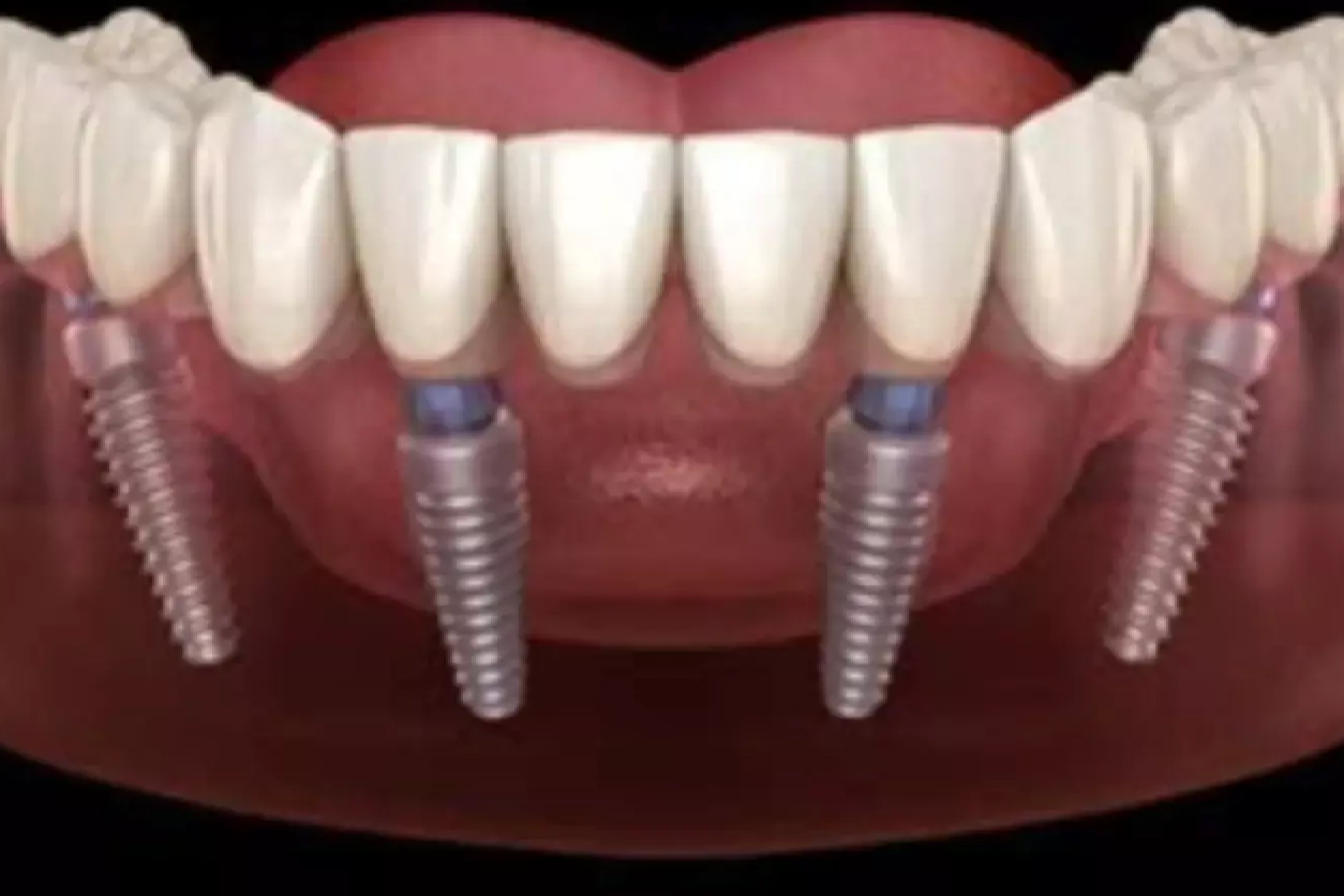 Full Mouth Reconstruction<br />