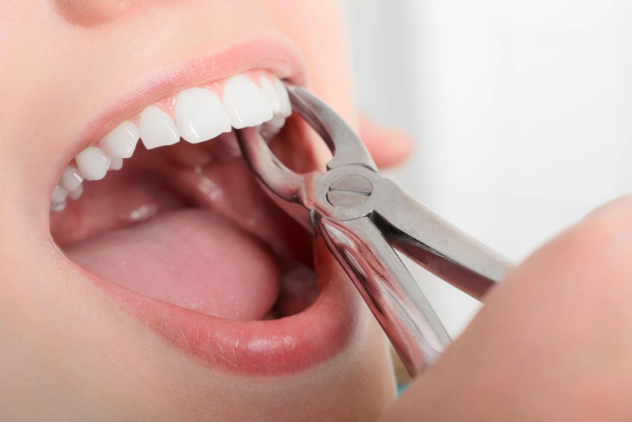 Tooth Extractions<br />