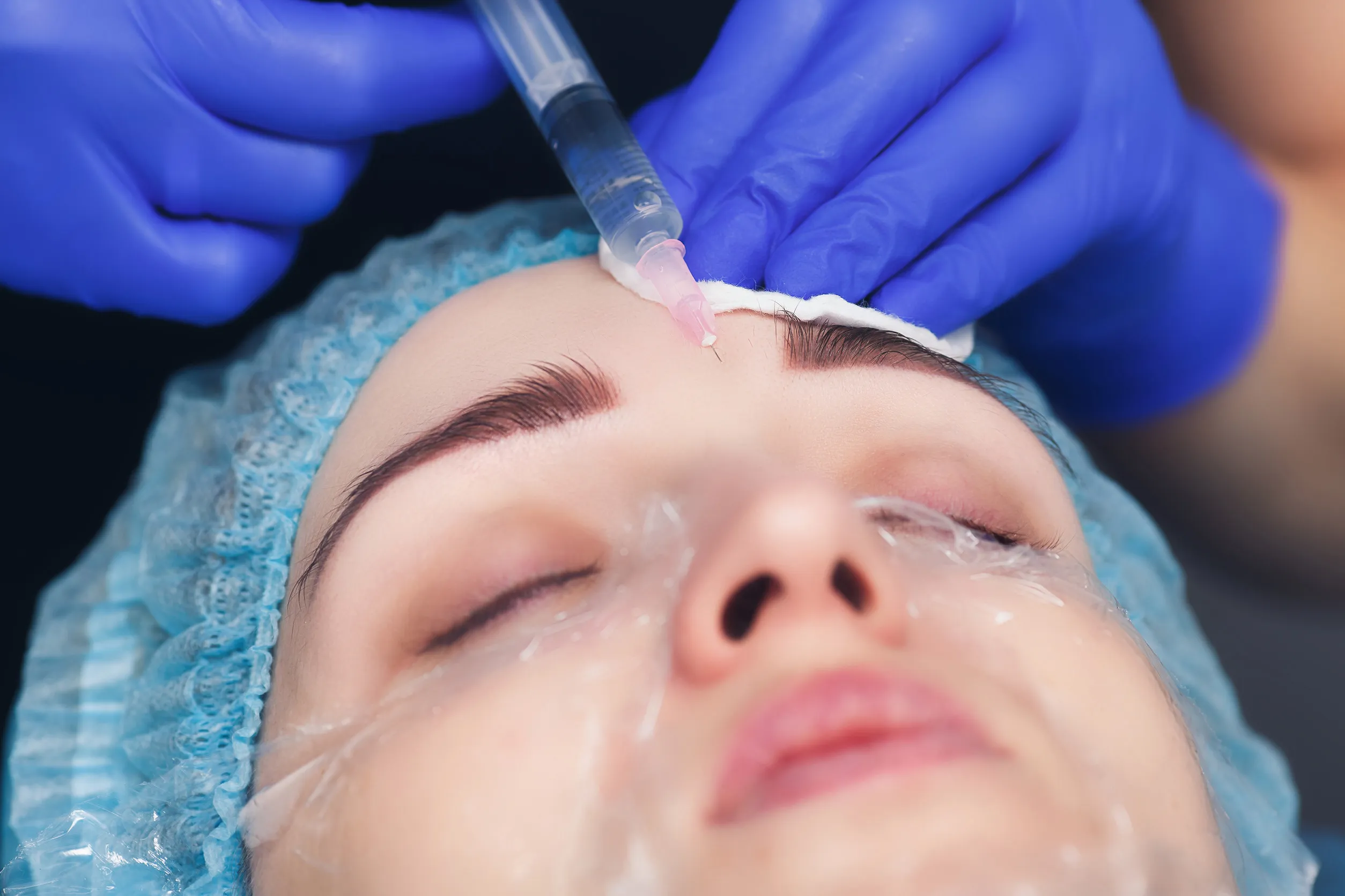 facial mesotherapy for smoothing mimic wrinkles on the forehead