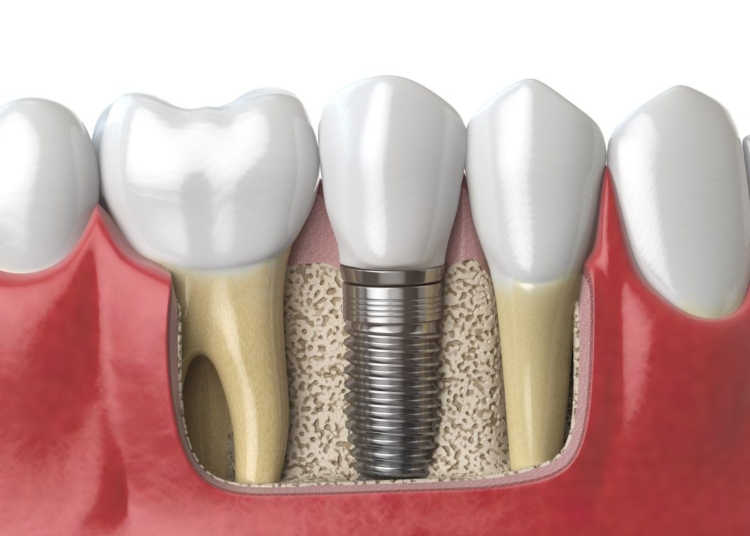 Services- dental implant placement